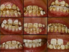 teeth_fluoride.jpg